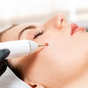 Elimina hasta 20 Lunares o Verrugas Sin Dolor con Láser, Por sólo $19.99 - Imagen 3